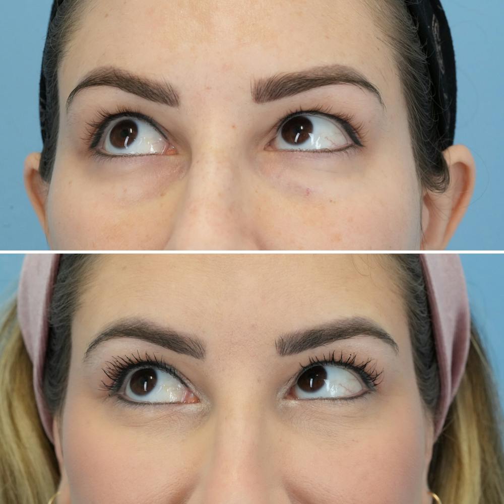 Blepharoplasty Before & After Gallery - Patient 220437 - Image 4