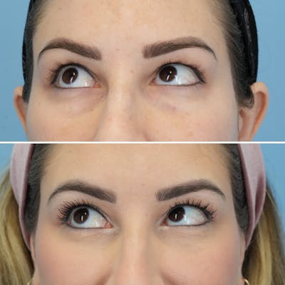 Blepharoplasty Before & After Gallery - Patient 220437 - Image 4