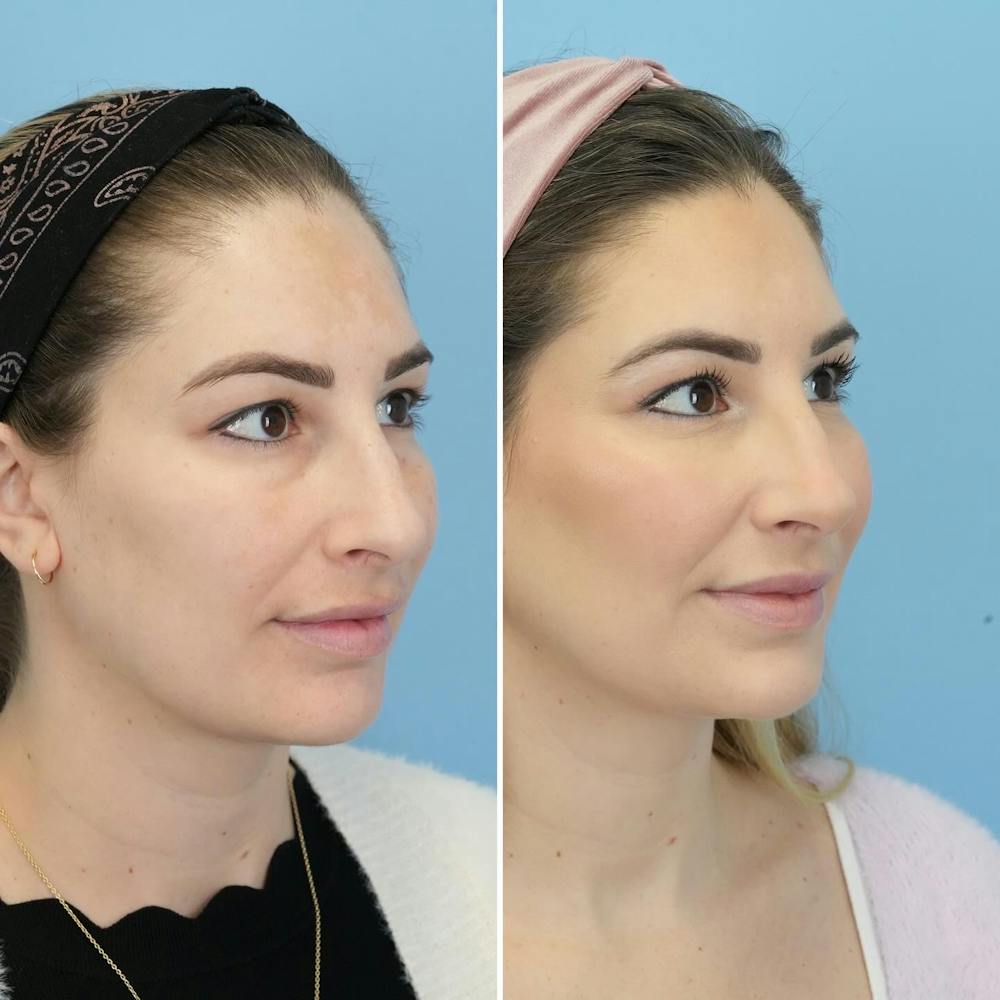 Blepharoplasty Before & After Gallery - Patient 220437 - Image 6
