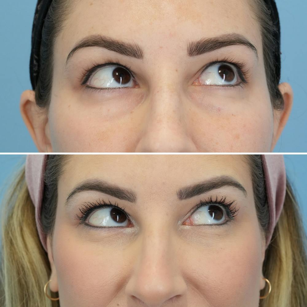Blepharoplasty Before & After Gallery - Patient 220437 - Image 3