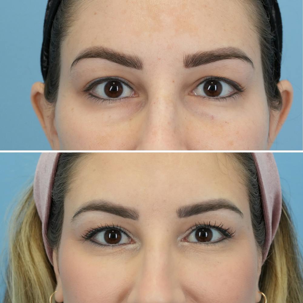 Blepharoplasty Before & After Gallery - Patient 220437 - Image 1