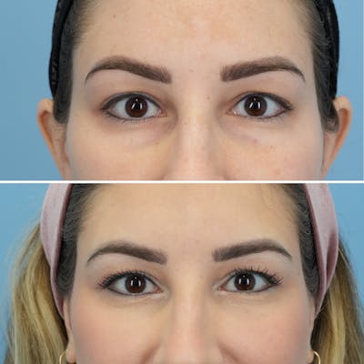 Blepharoplasty Before & After Gallery - Patient 220437 - Image 1