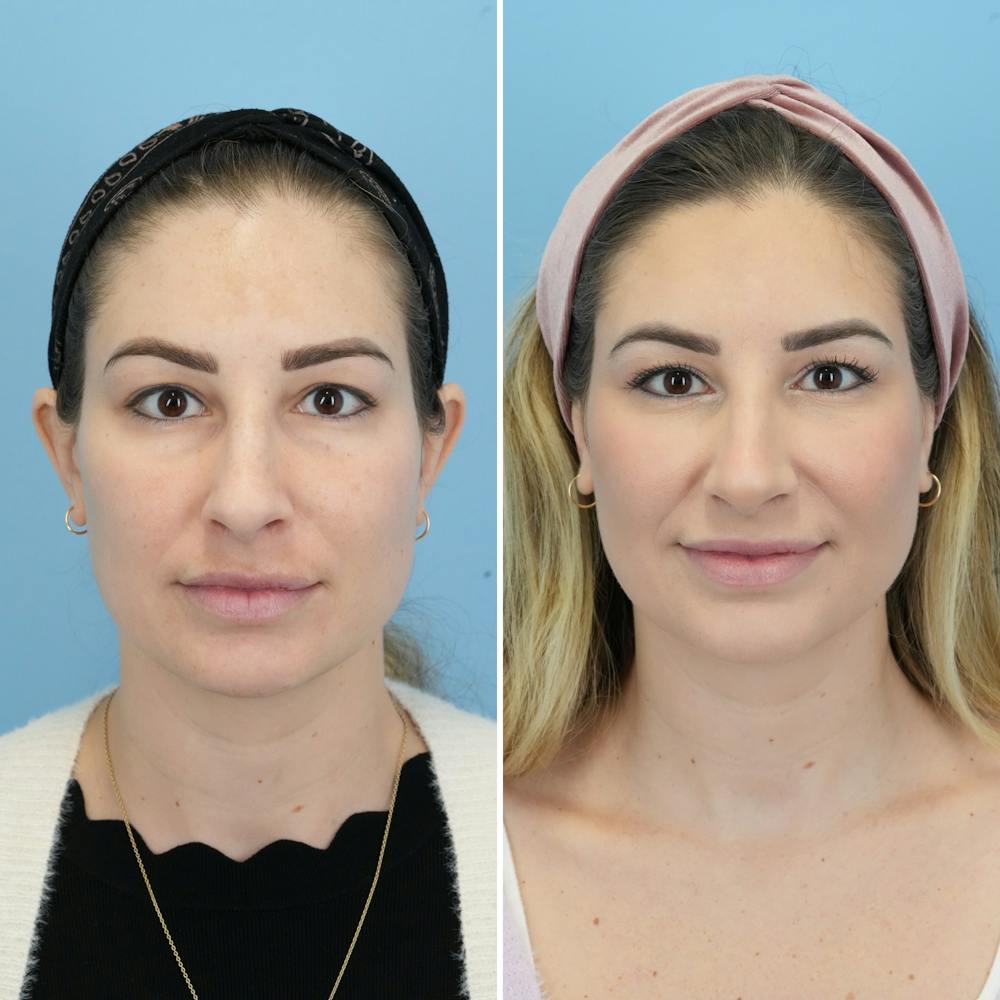 Blepharoplasty Before & After Gallery - Patient 220437 - Image 5