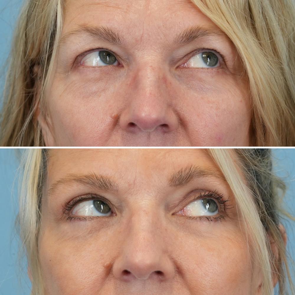 Blepharoplasty Before & After Gallery - Patient 403699 - Image 3