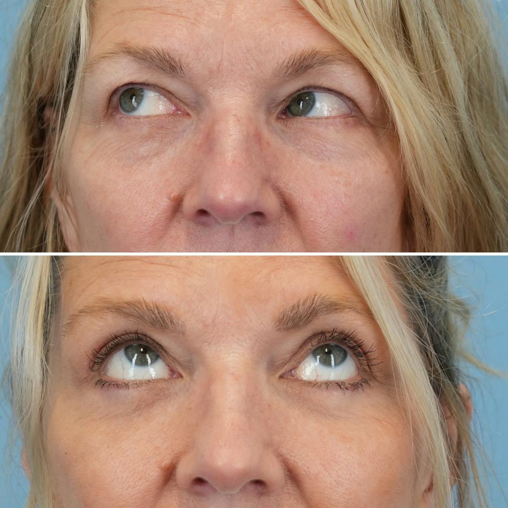 Blepharoplasty Before & After Gallery - Patient 403699 - Image 4