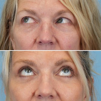 Blepharoplasty Before & After Gallery - Patient 403699 - Image 4