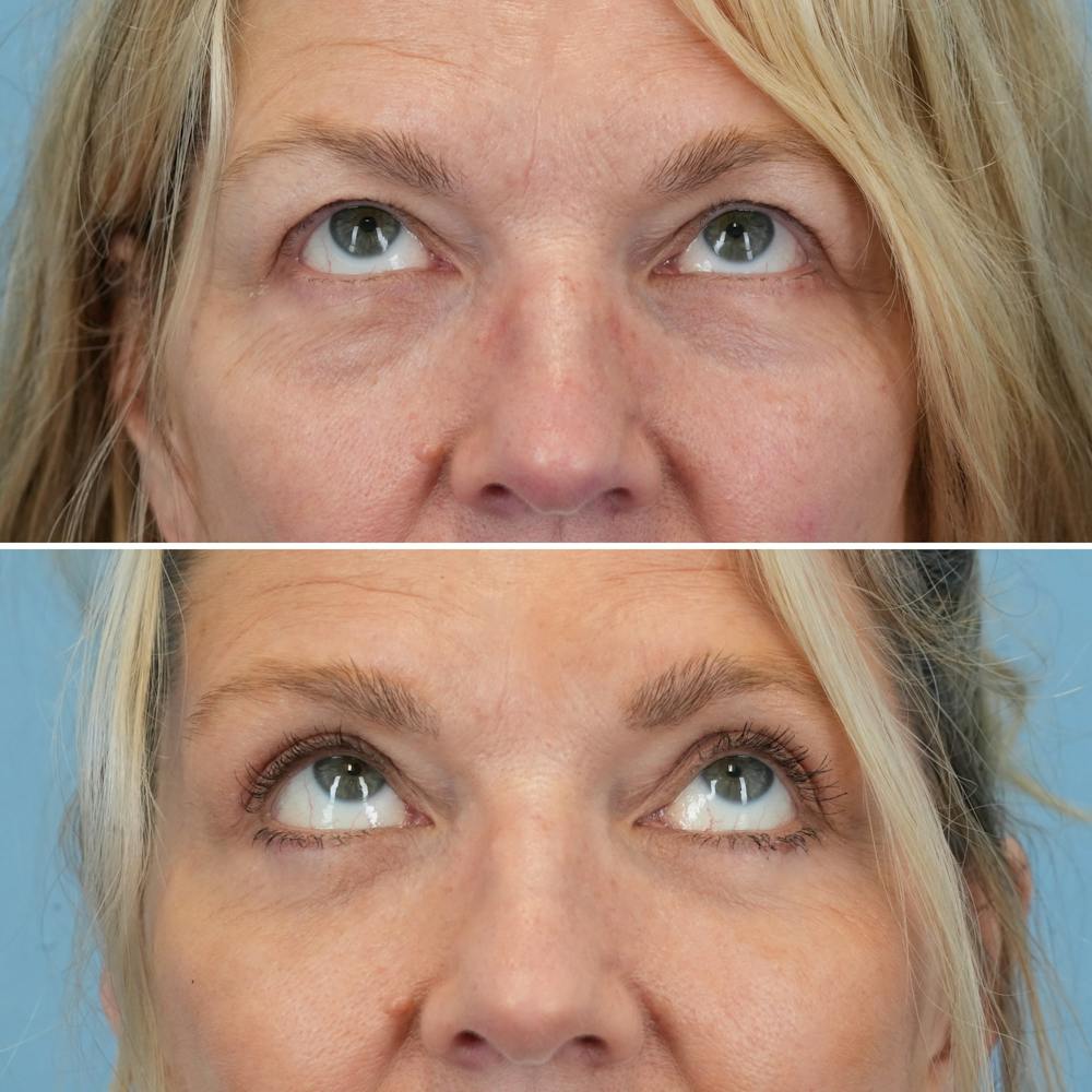 Blepharoplasty Before & After Gallery - Patient 403699 - Image 2