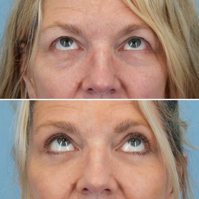 Blepharoplasty Before & After Gallery - Patient 403699 - Image 2