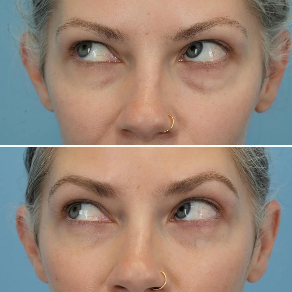 Blepharoplasty Before & After Gallery - Patient 128605 - Image 4