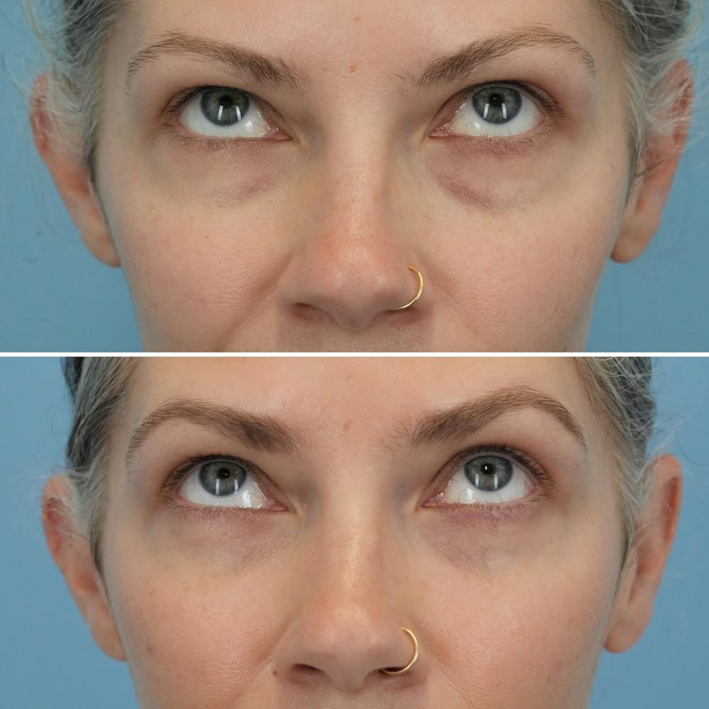 Blepharoplasty Before & After Gallery - Patient 128605 - Image 2