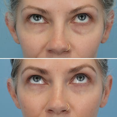 Blepharoplasty Before & After Gallery - Patient 128605 - Image 2