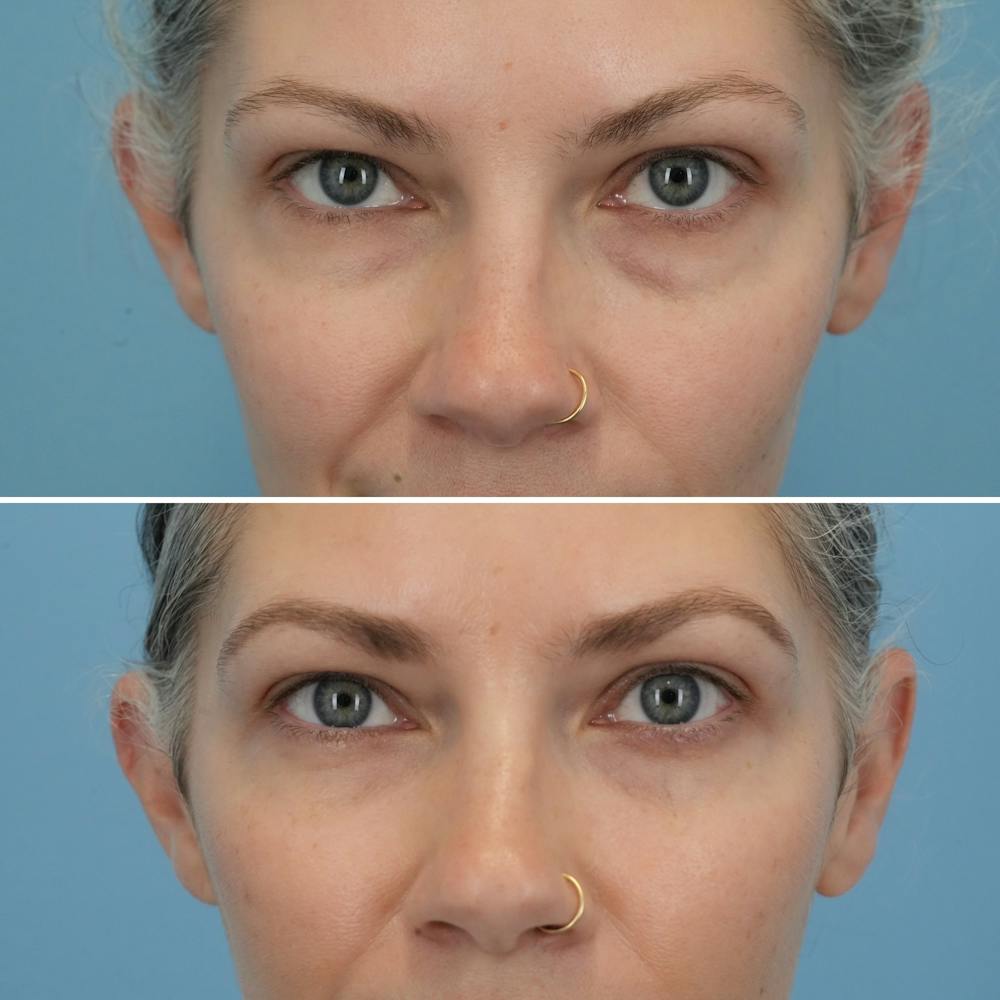 Blepharoplasty Before & After Gallery - Patient 128605 - Image 1