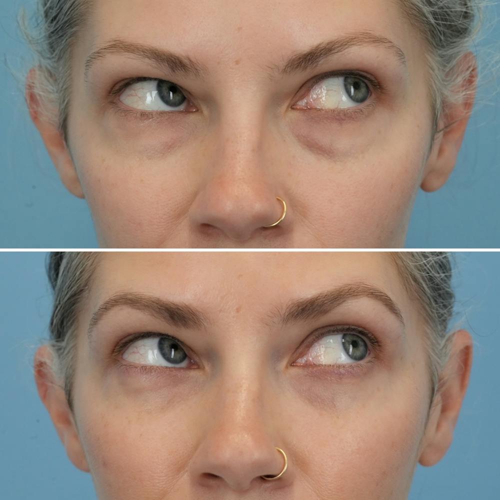 Blepharoplasty Before & After Gallery - Patient 128605 - Image 3