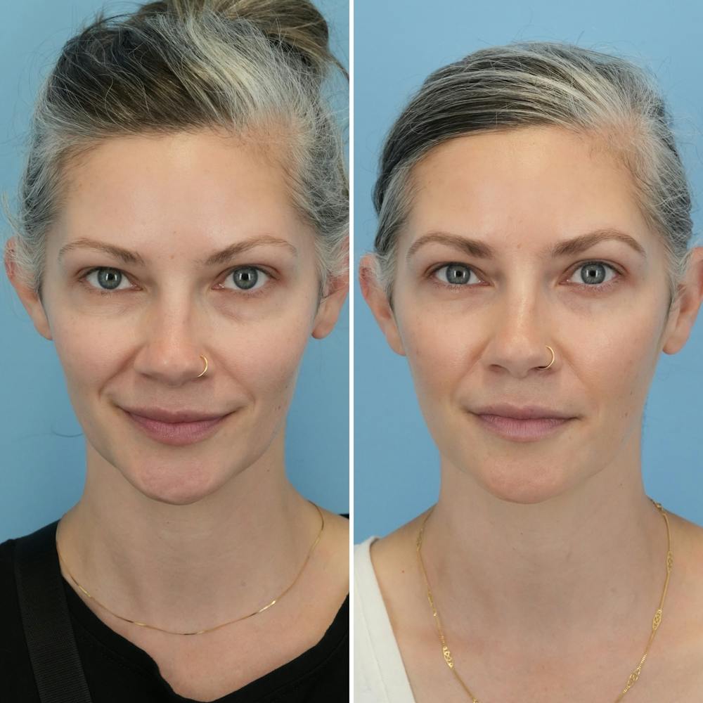 Blepharoplasty Before & After Gallery - Patient 128605 - Image 5