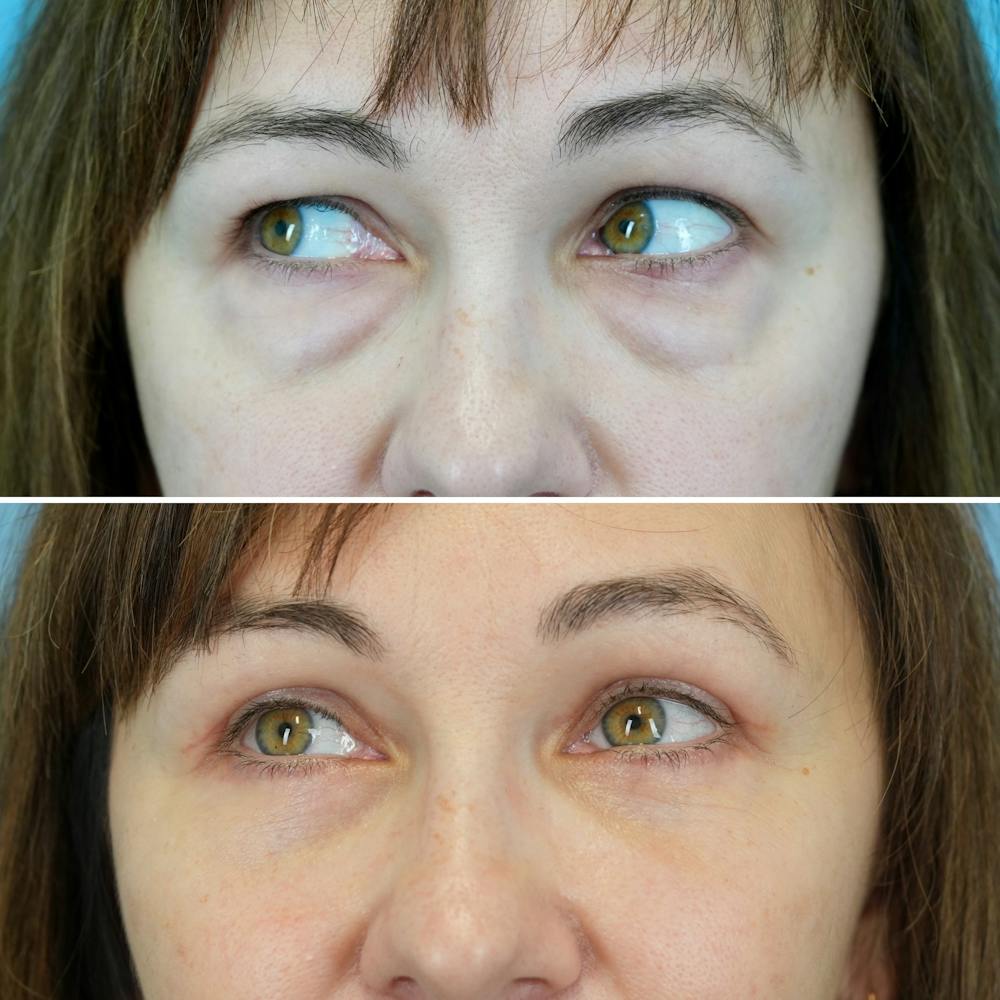 Blepharoplasty Before & After Gallery - Patient 207737 - Image 4