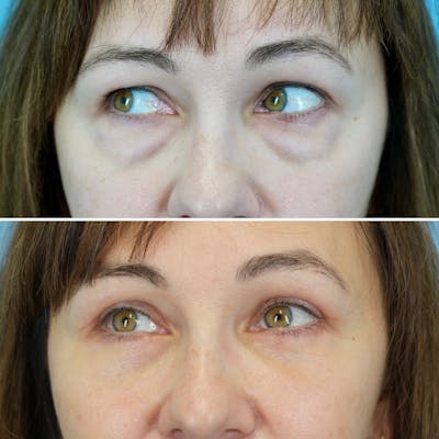 Blepharoplasty Before & After Gallery - Patient 207737 - Image 4