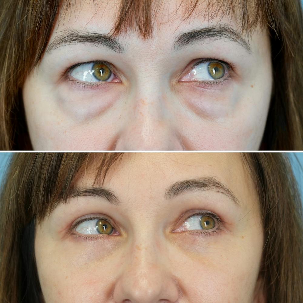 Blepharoplasty Before & After Gallery - Patient 207737 - Image 3
