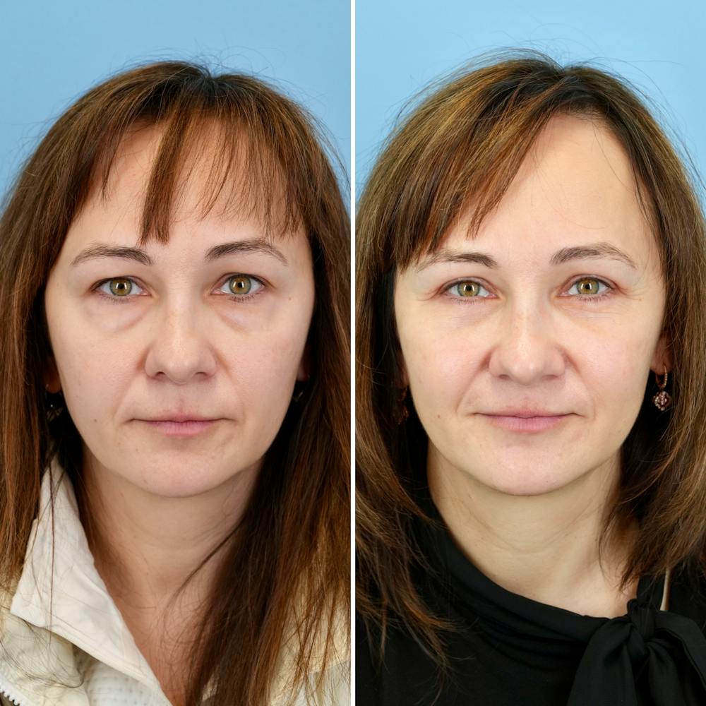 Blepharoplasty Before & After Gallery - Patient 207737 - Image 5