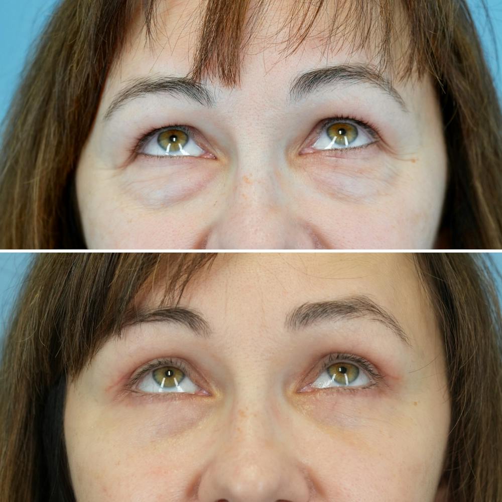 Blepharoplasty Before & After Gallery - Patient 207737 - Image 2