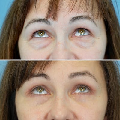Blepharoplasty Before & After Gallery - Patient 207737 - Image 2