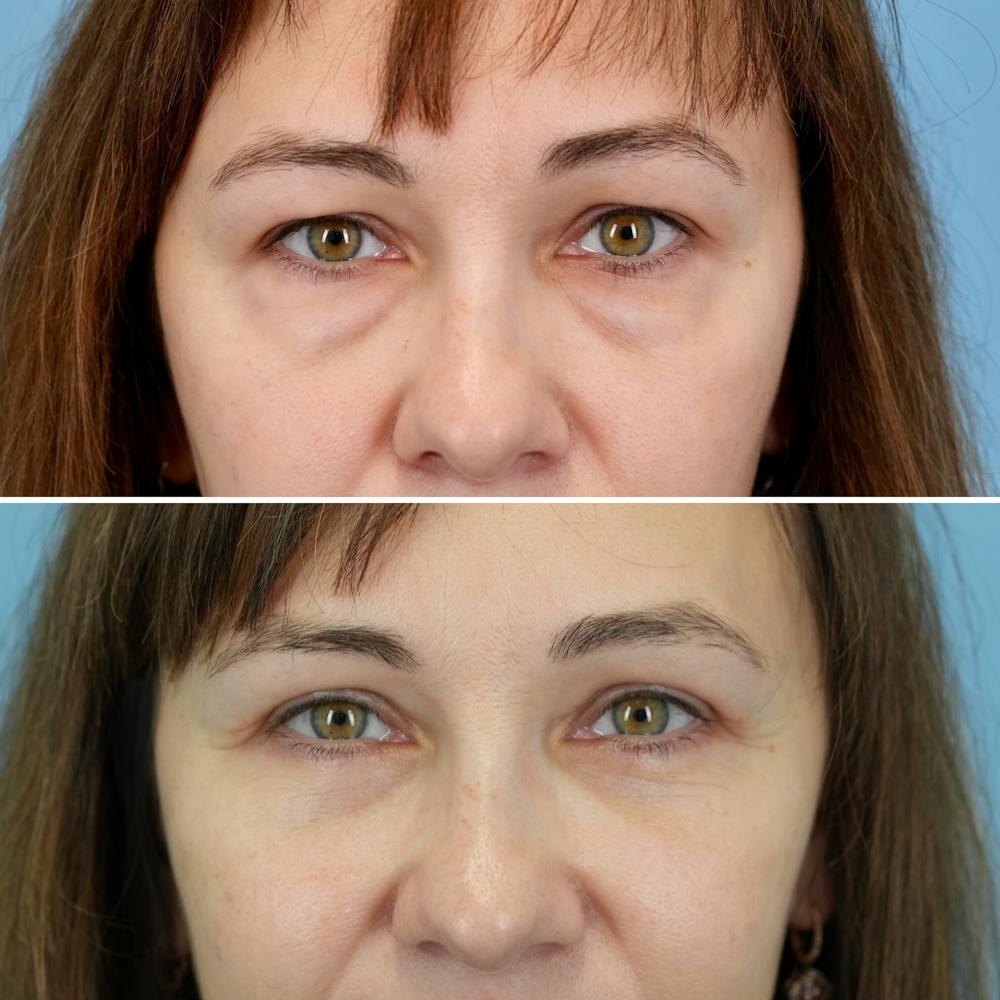 Blepharoplasty Before & After Gallery - Patient 207737 - Image 1