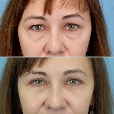 Blepharoplasty Before & After Gallery - Patient 207737 - Image 1