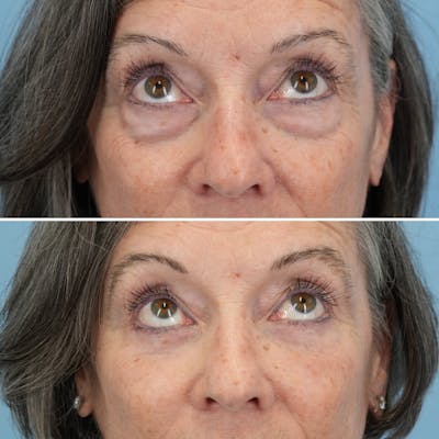 Blepharoplasty Before & After Gallery - Patient 122197 - Image 2