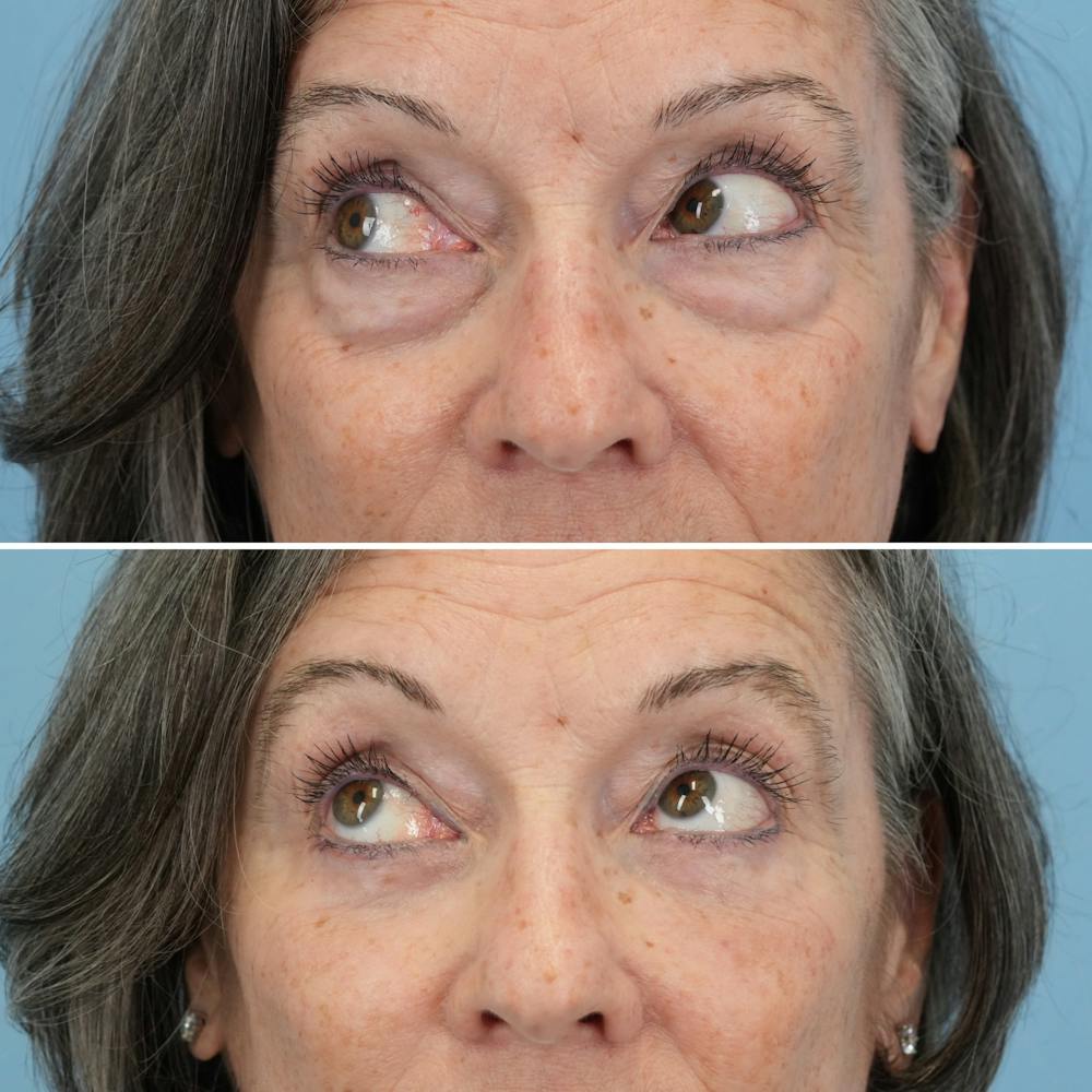 Blepharoplasty Before & After Gallery - Patient 122197 - Image 4