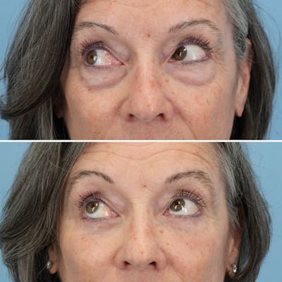 Blepharoplasty Before & After Gallery - Patient 122197 - Image 4
