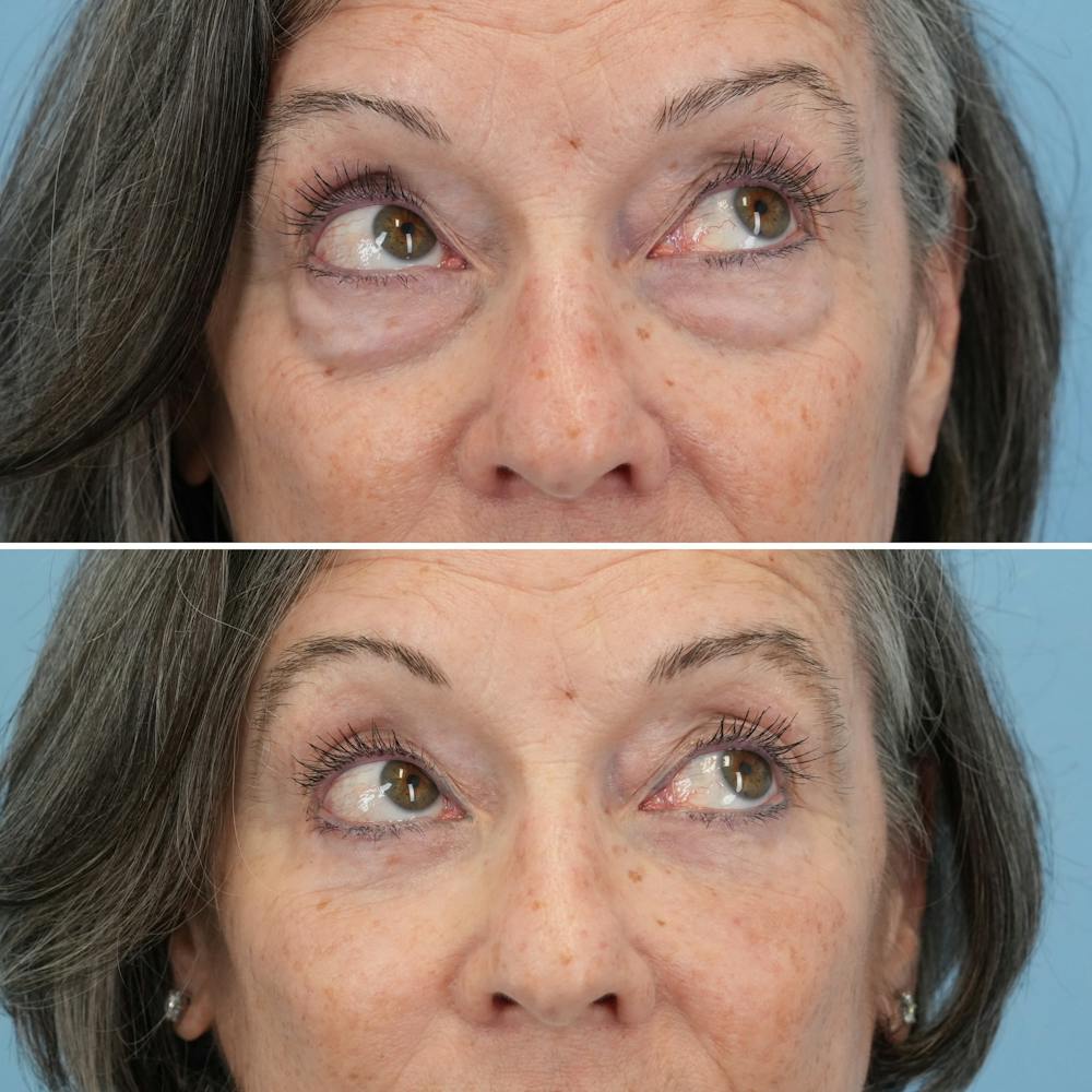 Blepharoplasty Before & After Gallery - Patient 122197 - Image 3