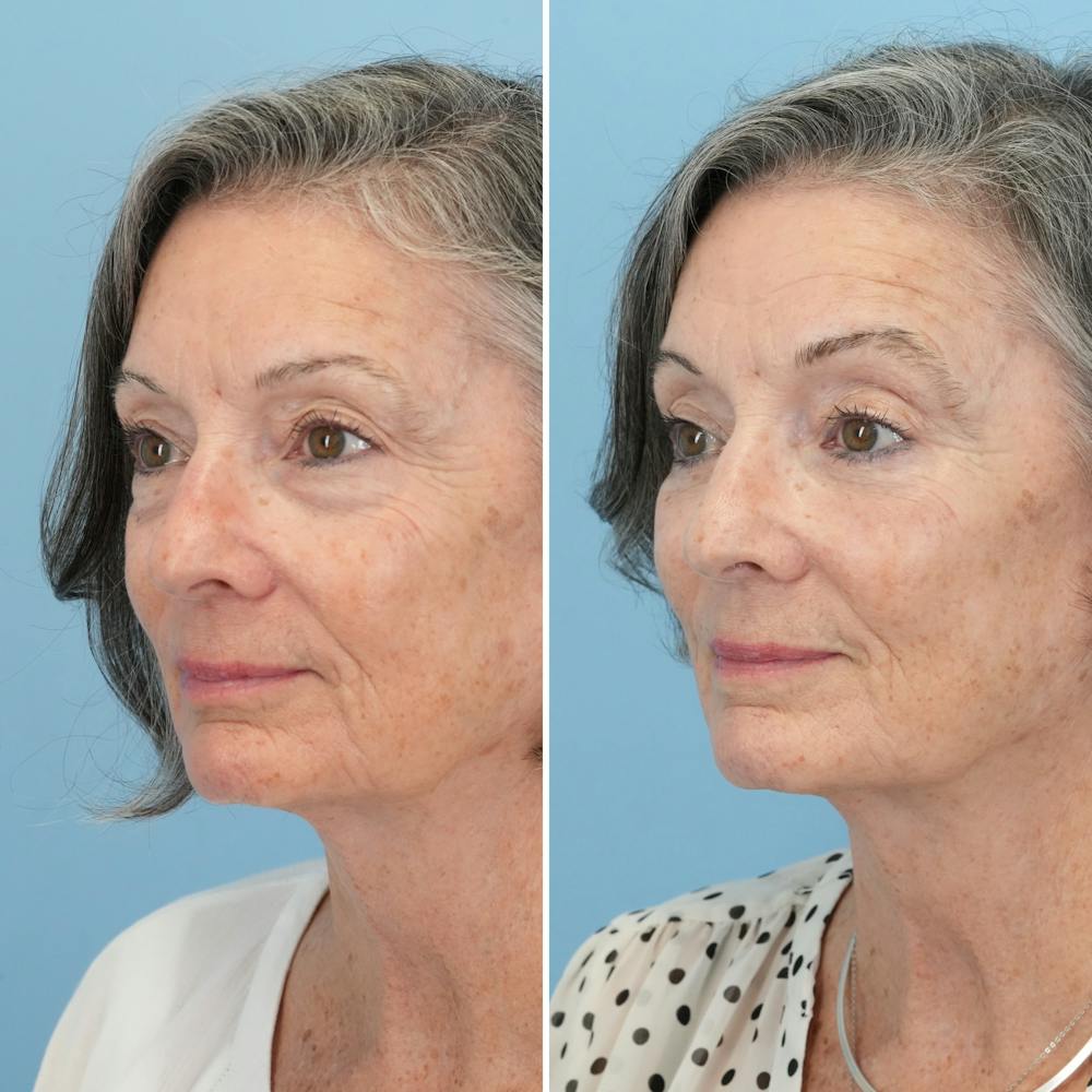 Blepharoplasty Before & After Gallery - Patient 122197 - Image 7