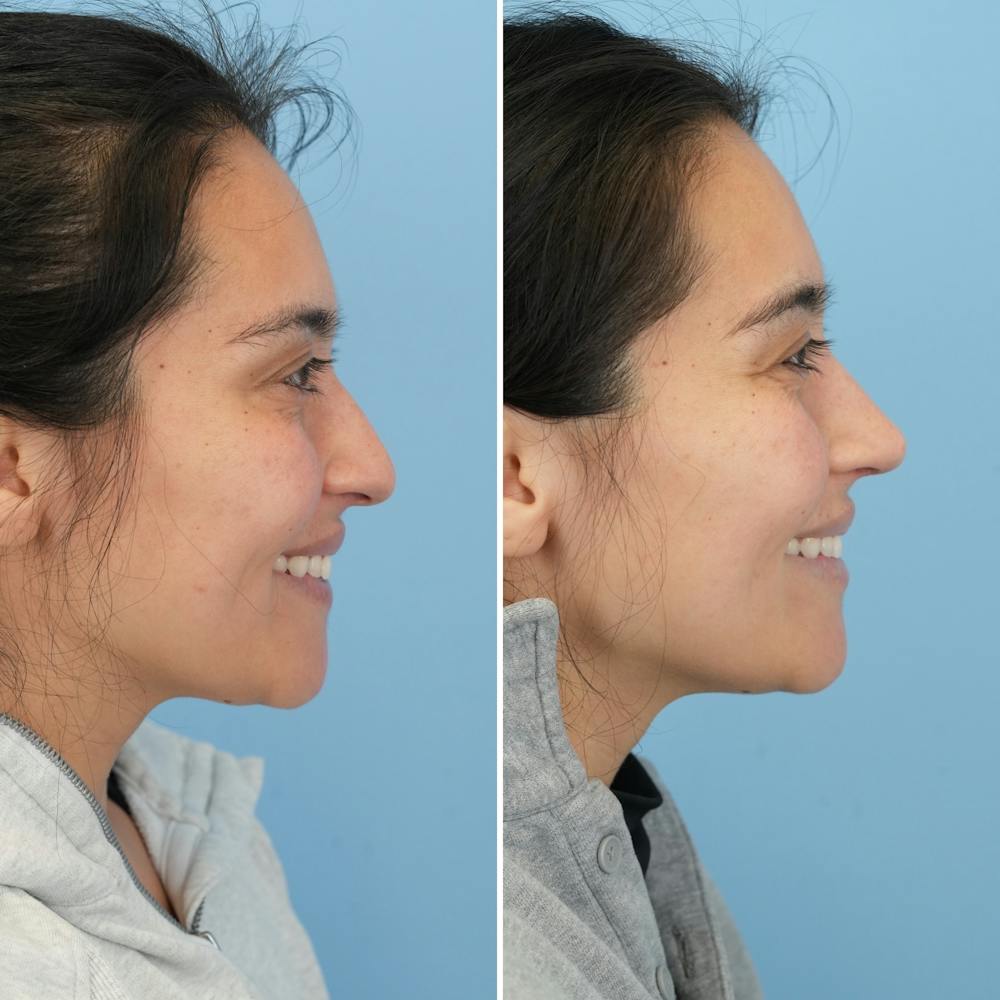 Rhinoplasty Before & After Gallery - Patient 352563 - Image 2