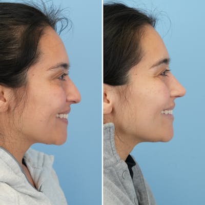 Rhinoplasty Before & After Gallery - Patient 352563 - Image 2