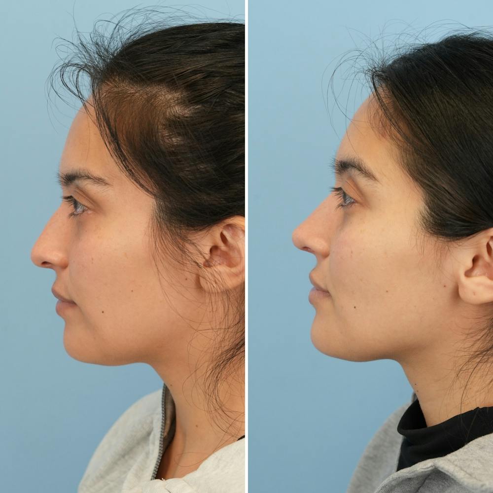Rhinoplasty Before & After Gallery - Patient 352563 - Image 7