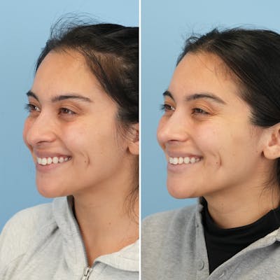 Rhinoplasty Before & After Gallery - Patient 352563 - Image 6