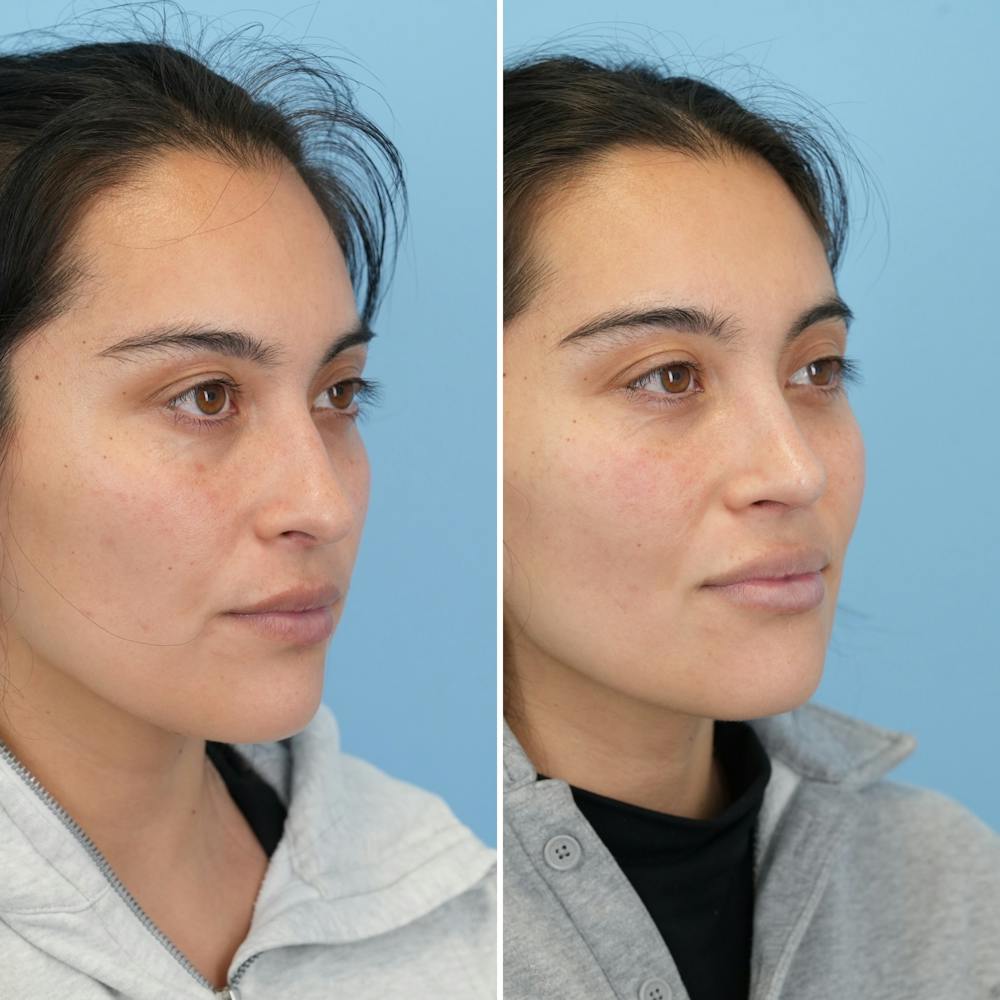 Rhinoplasty Before & After Gallery - Patient 352563 - Image 3