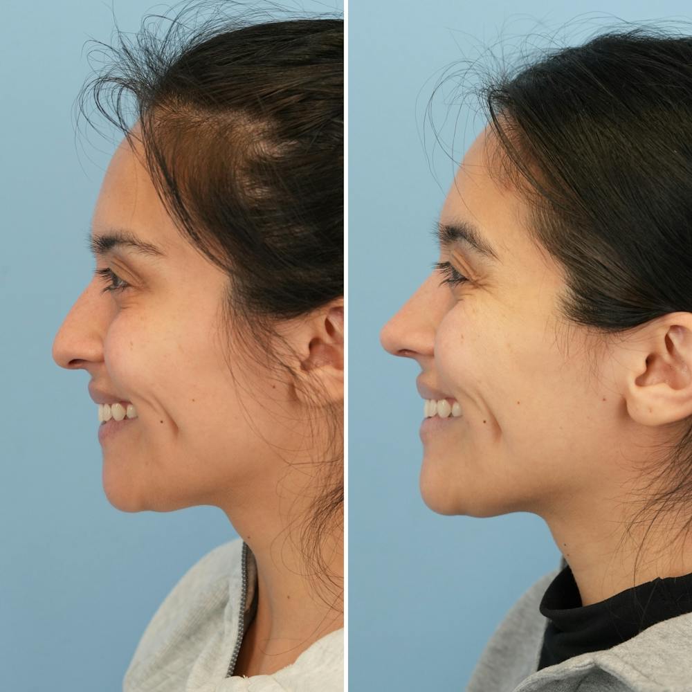 Rhinoplasty Before & After Gallery - Patient 352563 - Image 8