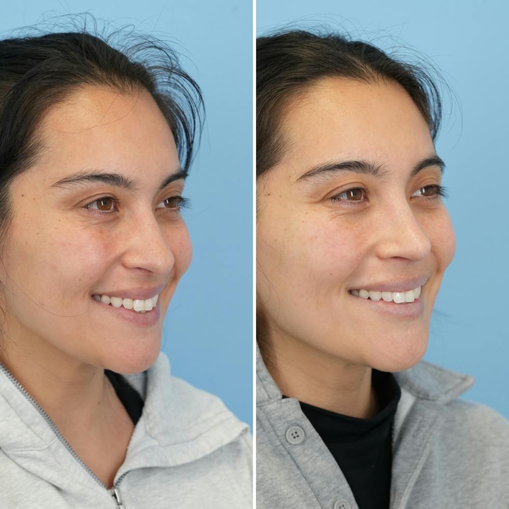 Rhinoplasty Before & After Gallery - Patient 352563 - Image 4