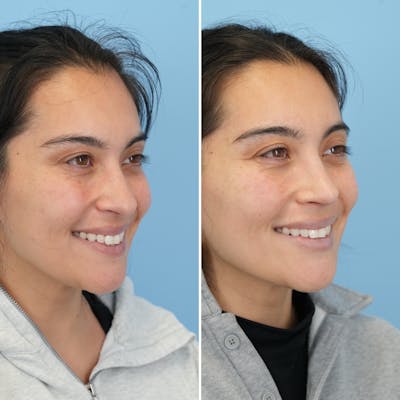 Rhinoplasty Before & After Gallery - Patient 352563 - Image 4