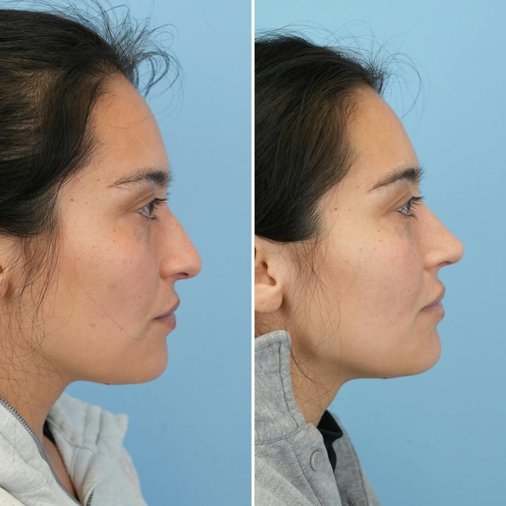 Rhinoplasty Before & After Gallery - Patient 352563 - Image 1