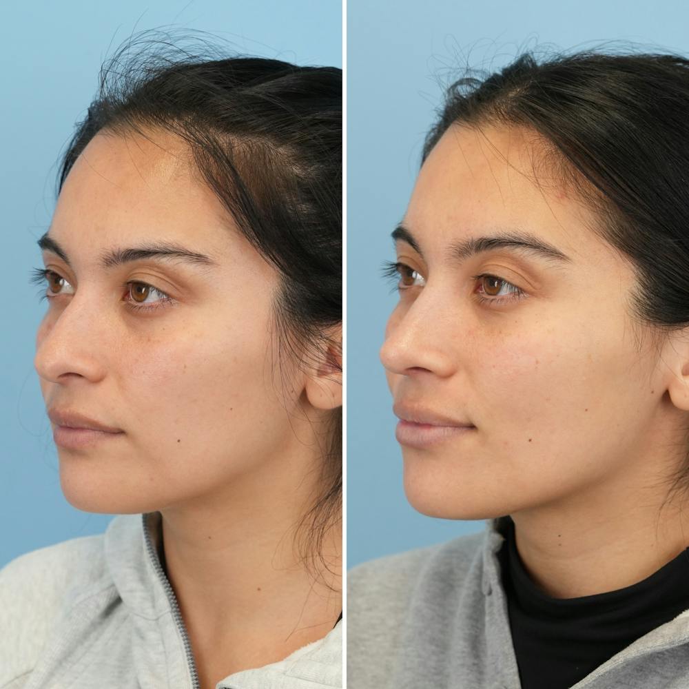 Rhinoplasty Before & After Gallery - Patient 352563 - Image 5