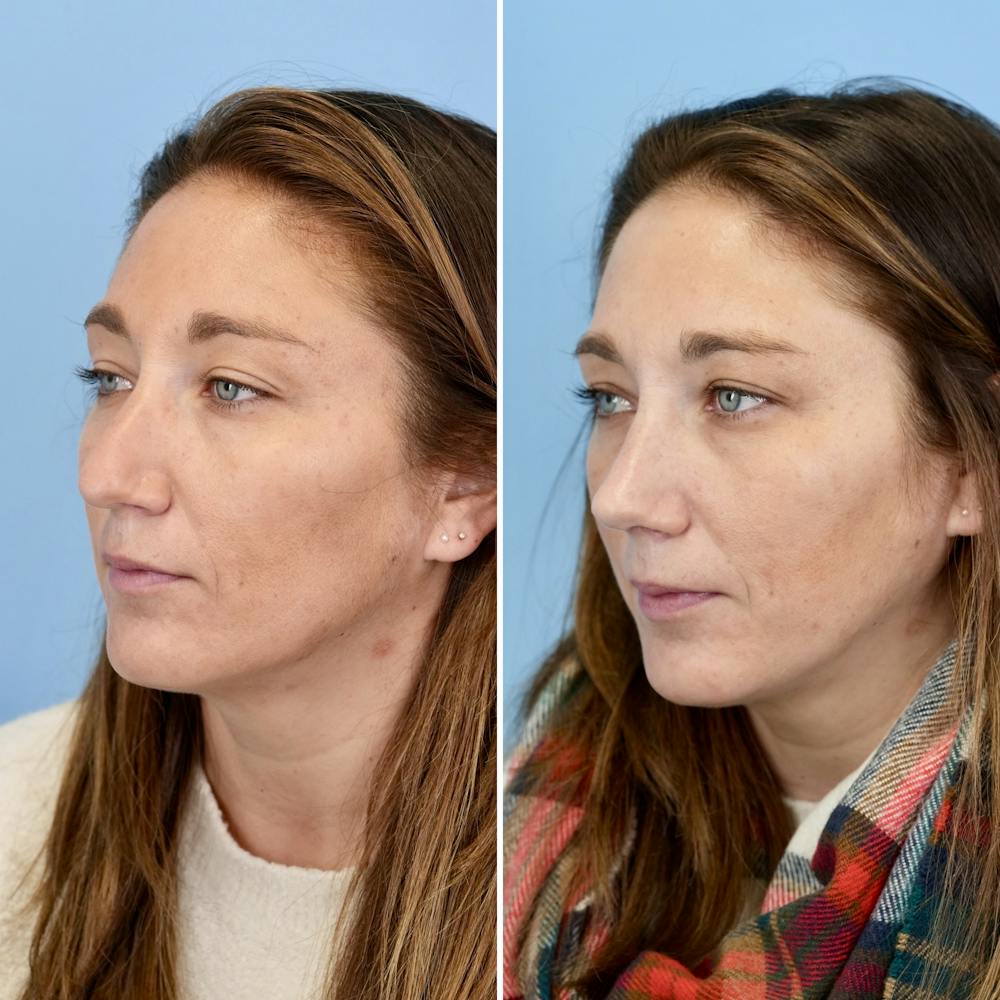 Rhinoplasty Before & After Gallery - Patient 237180 - Image 6