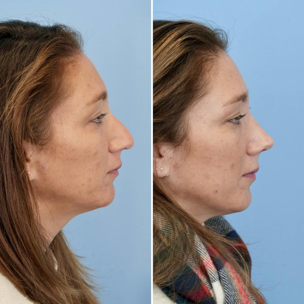 Rhinoplasty Before & After Gallery - Patient 237180 - Image 1