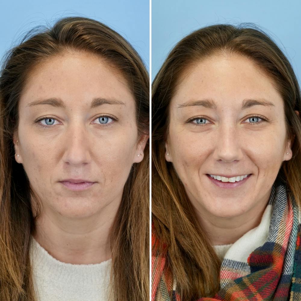Rhinoplasty Before & After Gallery - Patient 237180 - Image 5