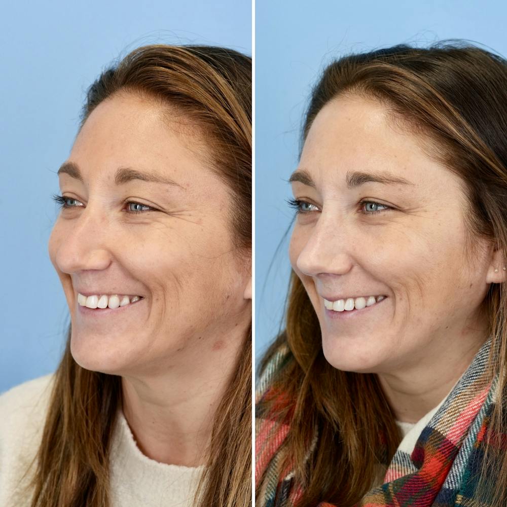 Rhinoplasty Before & After Gallery - Patient 237180 - Image 7