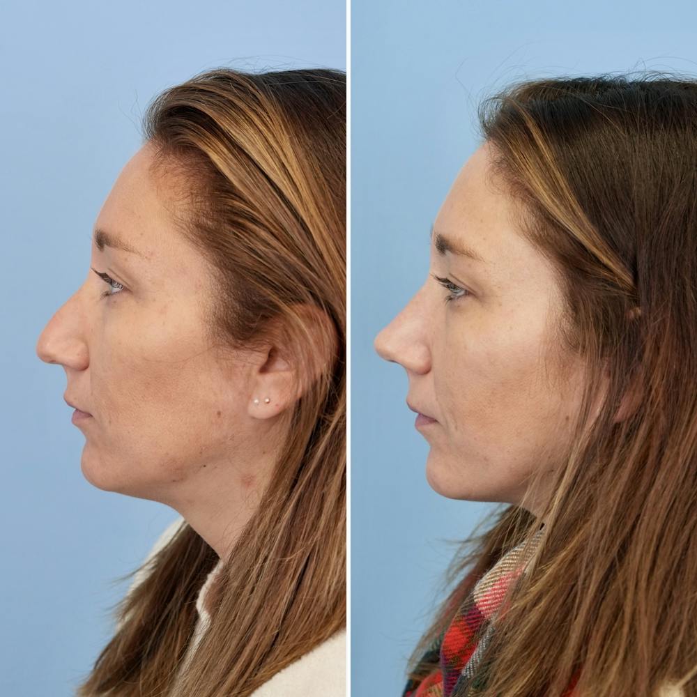 Rhinoplasty Before & After Gallery - Patient 237180 - Image 8