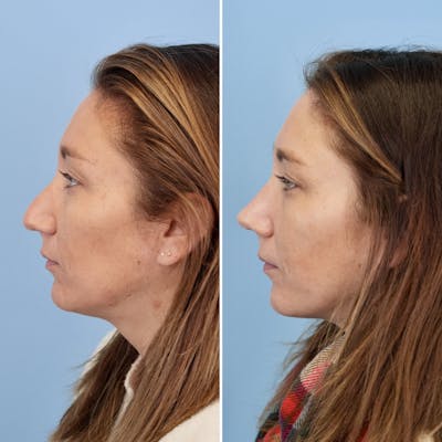 Rhinoplasty Before & After Gallery - Patient 237180 - Image 8