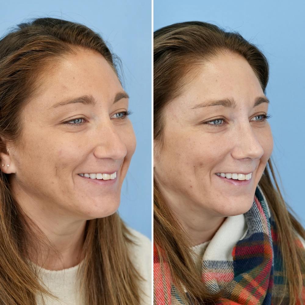 Rhinoplasty Before & After Gallery - Patient 237180 - Image 4