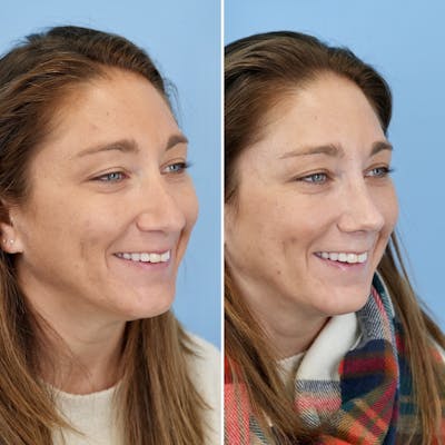 Rhinoplasty Before & After Gallery - Patient 237180 - Image 4