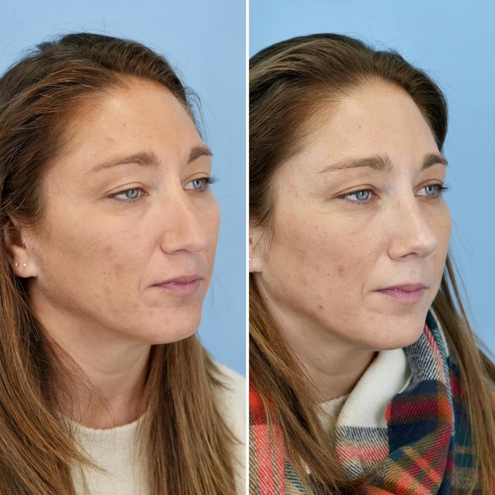 Rhinoplasty Before & After Gallery - Patient 237180 - Image 3